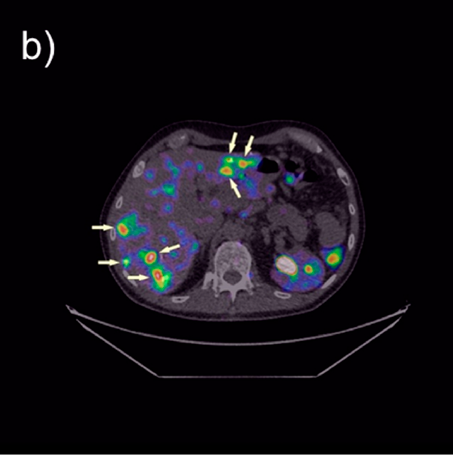 Zdjęcie (w orientacji poprzecznej) tomografii komputerowej (a) oraz złożenie obrazu z tomografu komputerowego i z tomografu emisyjnego pojedynczych fotonów (b) pacjenta z rakiem rdzeniastym tarczycy, przy znakowaniu galem-68. Zdjęcia wykonano 4h od podania mniejszej, niż przy znakowaniu indem, dawki peptydu. Strzałkami zaznaczono przerzuty nowotworowe w wątrobie. Zdjęcie wykonano w Collegium Medicum Uniwersytetu Jagiellońskiego. Właścicielem zdjęcia jest MDPI, Basel, Switzerland; opublikowano w ramach lice
